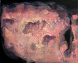 PETRIFICACION