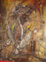 Elefantiasis