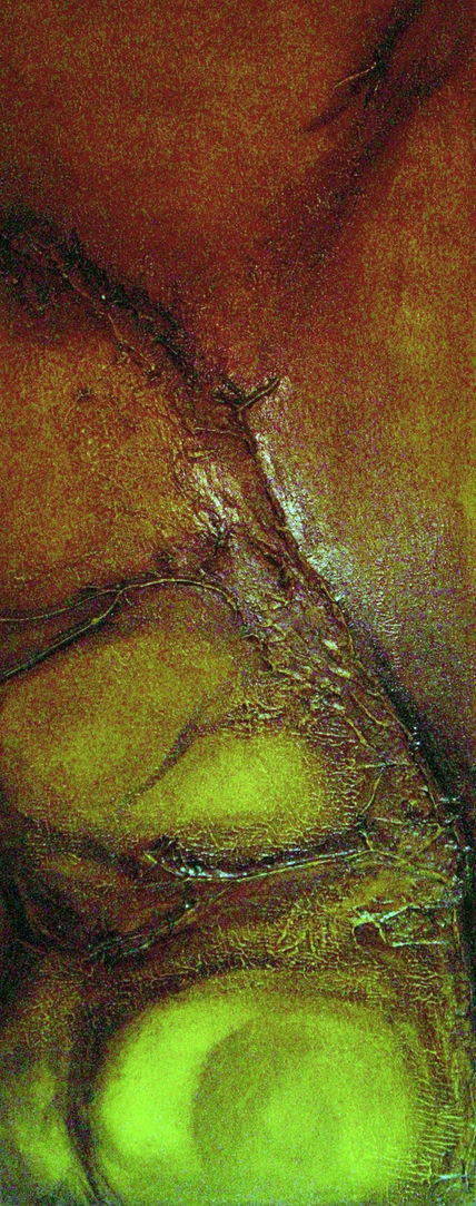Cicatrízes