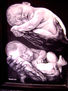 prematuros.