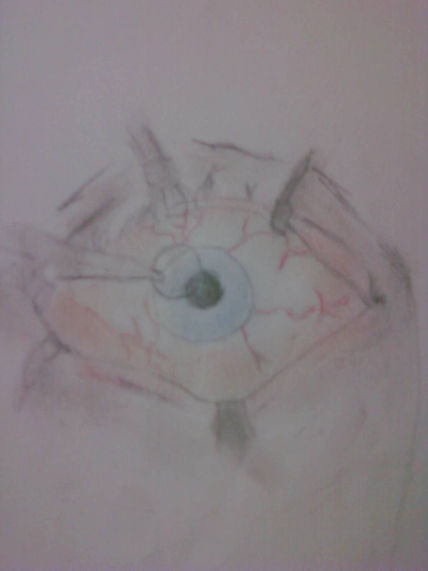 Operacion ocular
