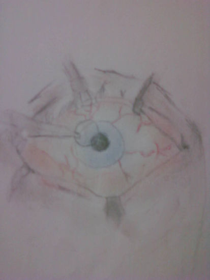 operacion ocular 