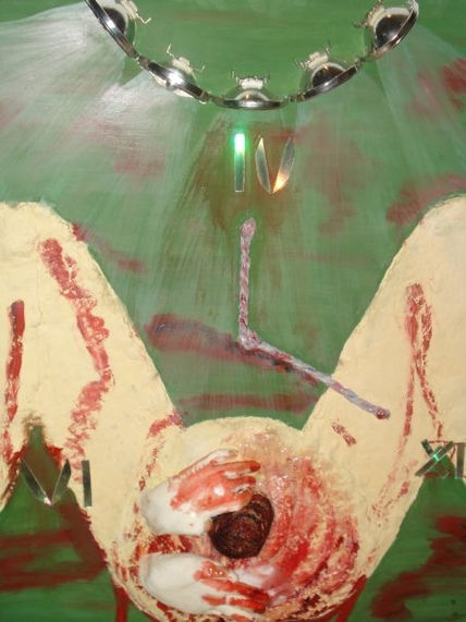 Trauma