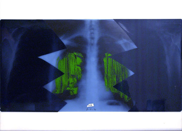 Pulmones
