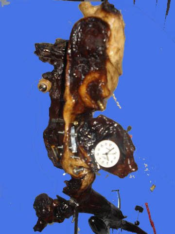 A SAINT BERNARD WITH TOADLIKE HEAD SAINT BURN HARD