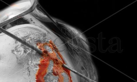 heridas